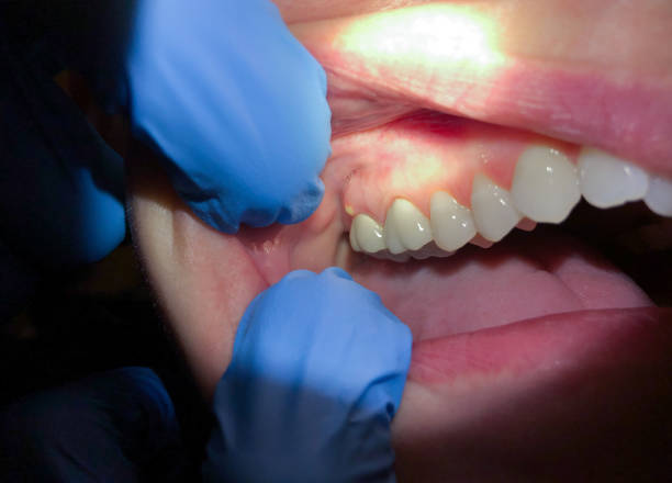 Best Dental Abscess Treatment in Sterling Ranch, CO